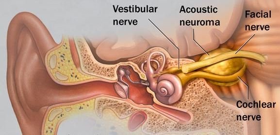 Neurinom acustic